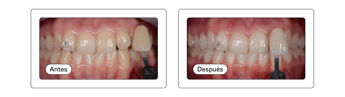 es before after blog